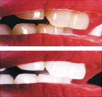 Laser teeth whitening