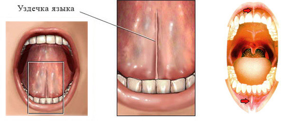 Frenum plasty with LASER