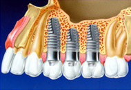 Implante dentare